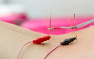 Electroacupuncture-1-1024x683